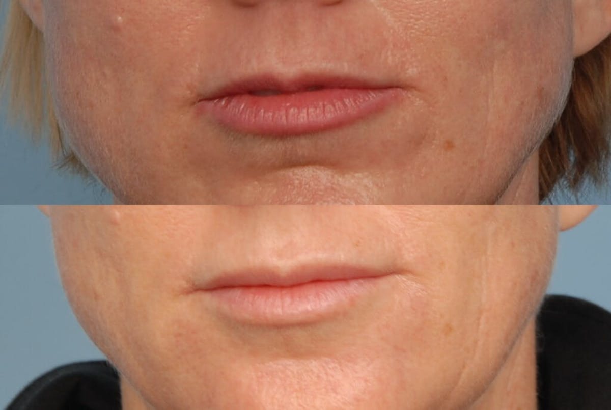 Lips Before & After Gallery - Patient 426654 - Image 1