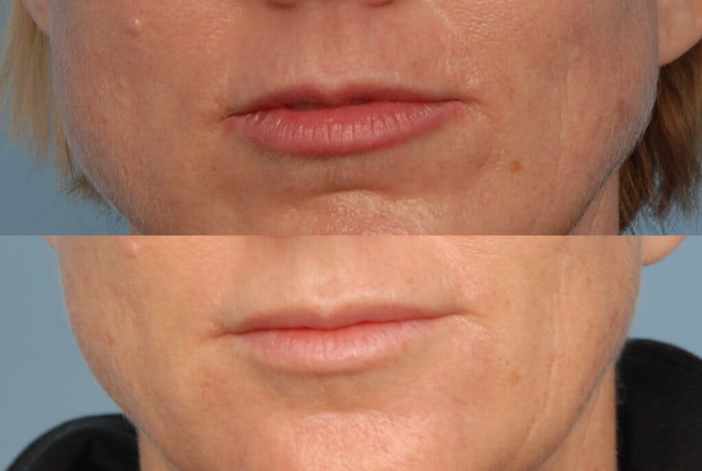 Juvederm Before & After Gallery - Patient 42065743 - Image 1