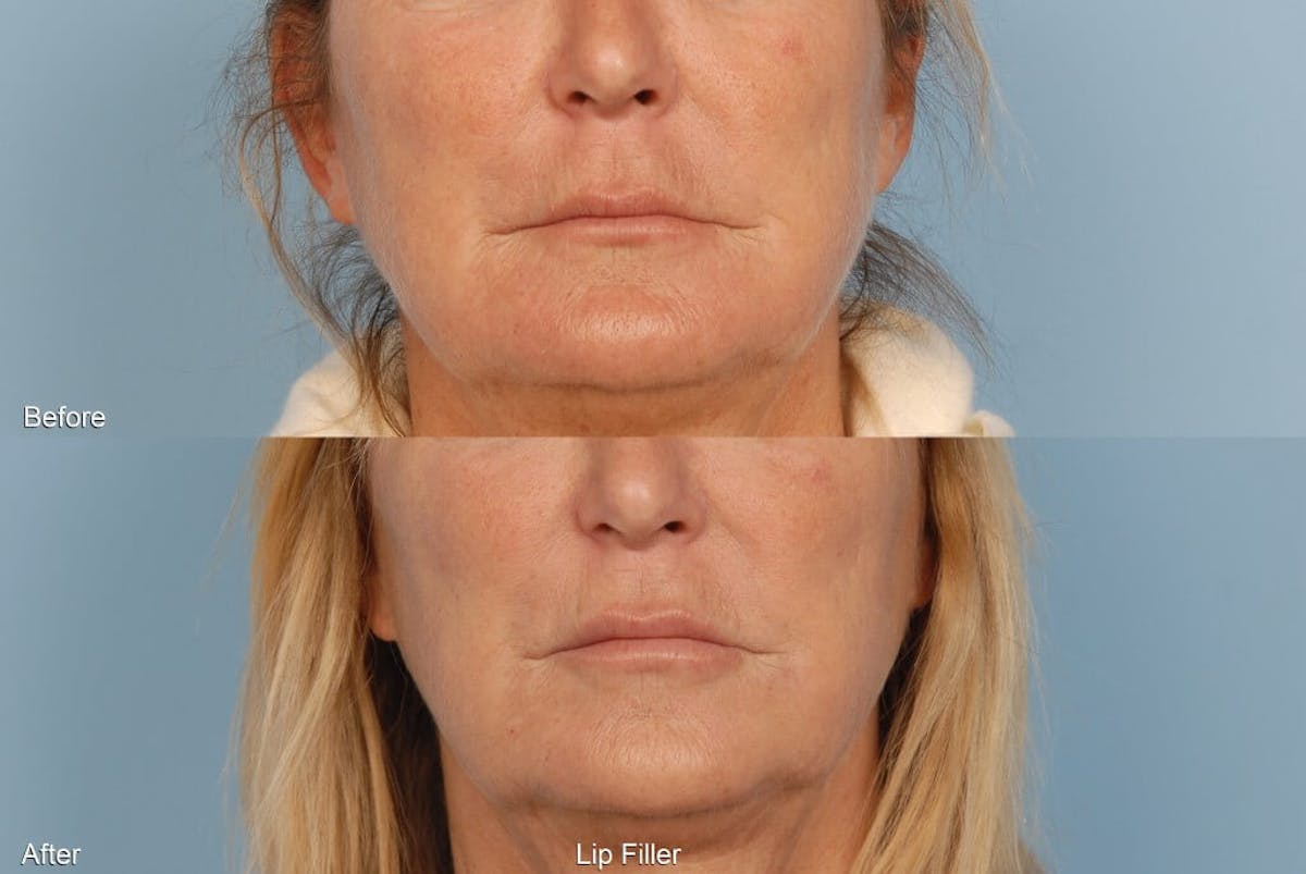 Lower Face Before & After Gallery - Patient 844984 - Image 1