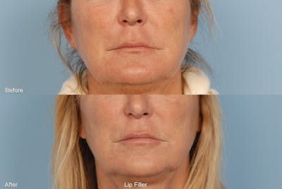 Lower Face Before & After Gallery - Patient 844984 - Image 1