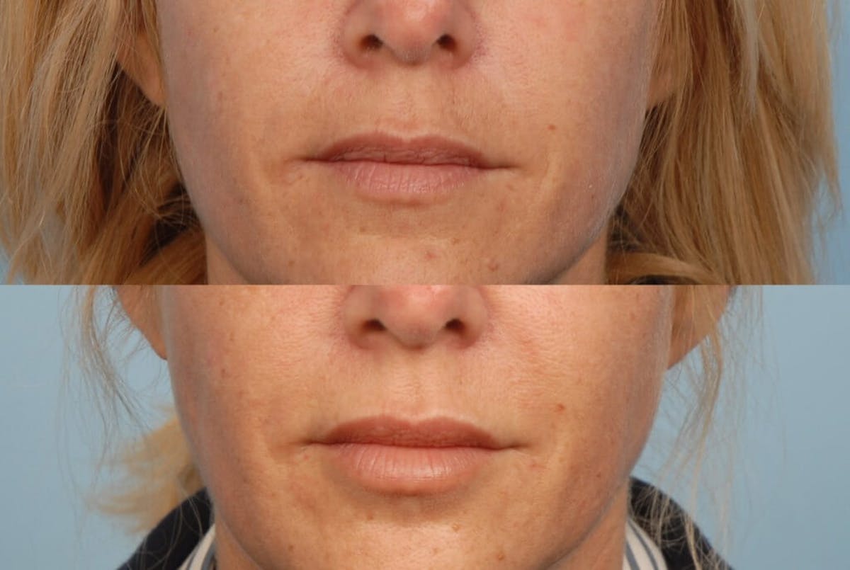 Lips Before & After Gallery - Patient 199944 - Image 1