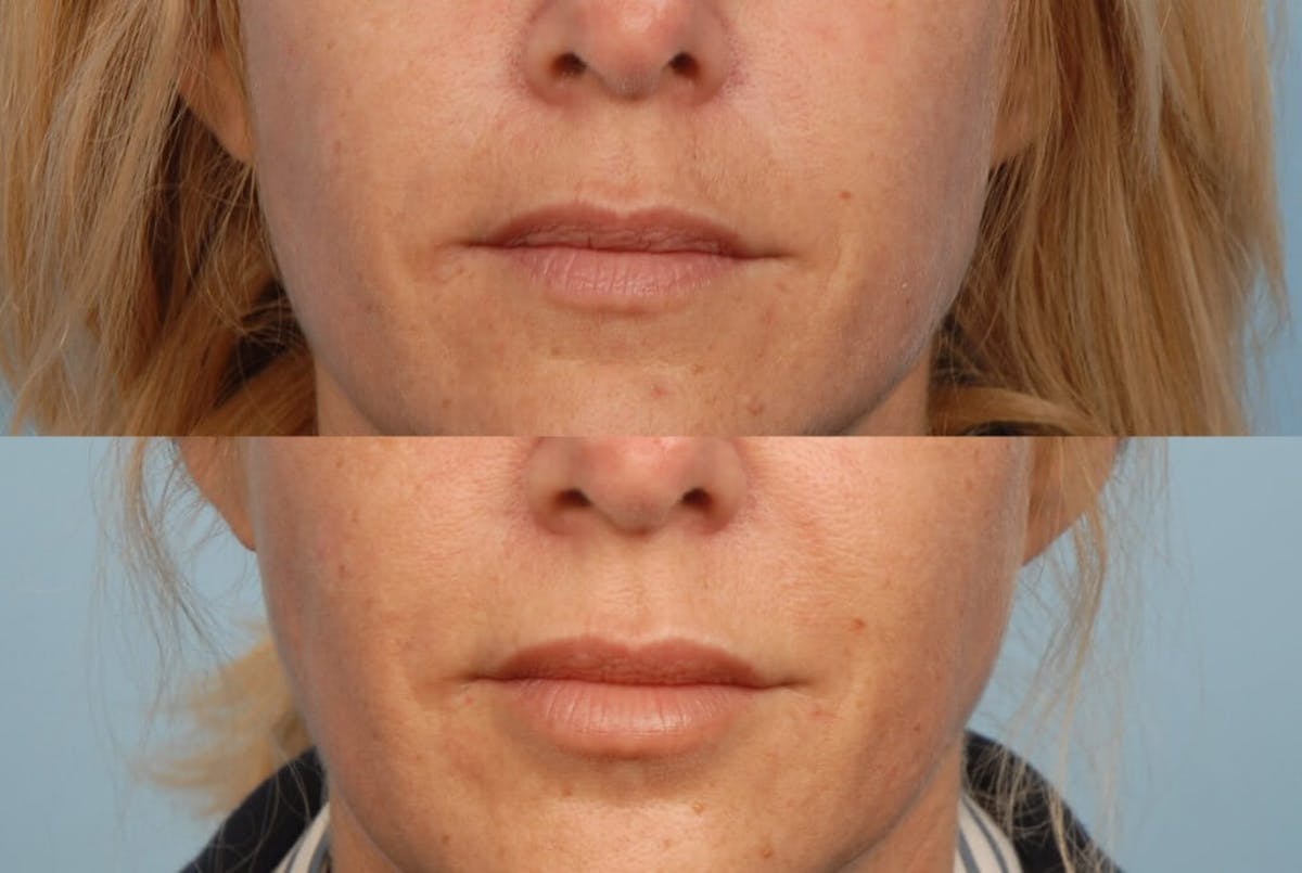 Fillers Before & After Gallery - Patient 173990092 - Image 1