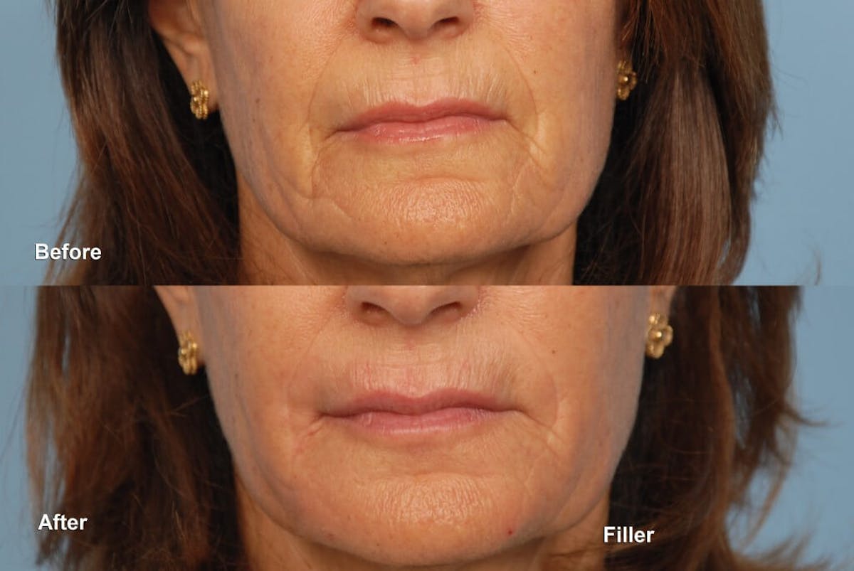 Lower Face Before & After Gallery - Patient 190323 - Image 1
