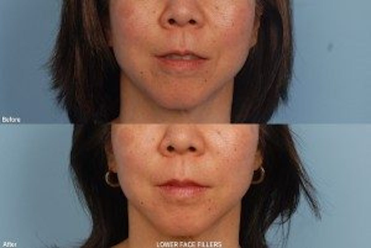 Fillers Before & After Gallery - Patient 173990096 - Image 1