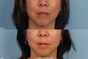 Juvederm Before & After Gallery - Patient 42065747 - Image 1