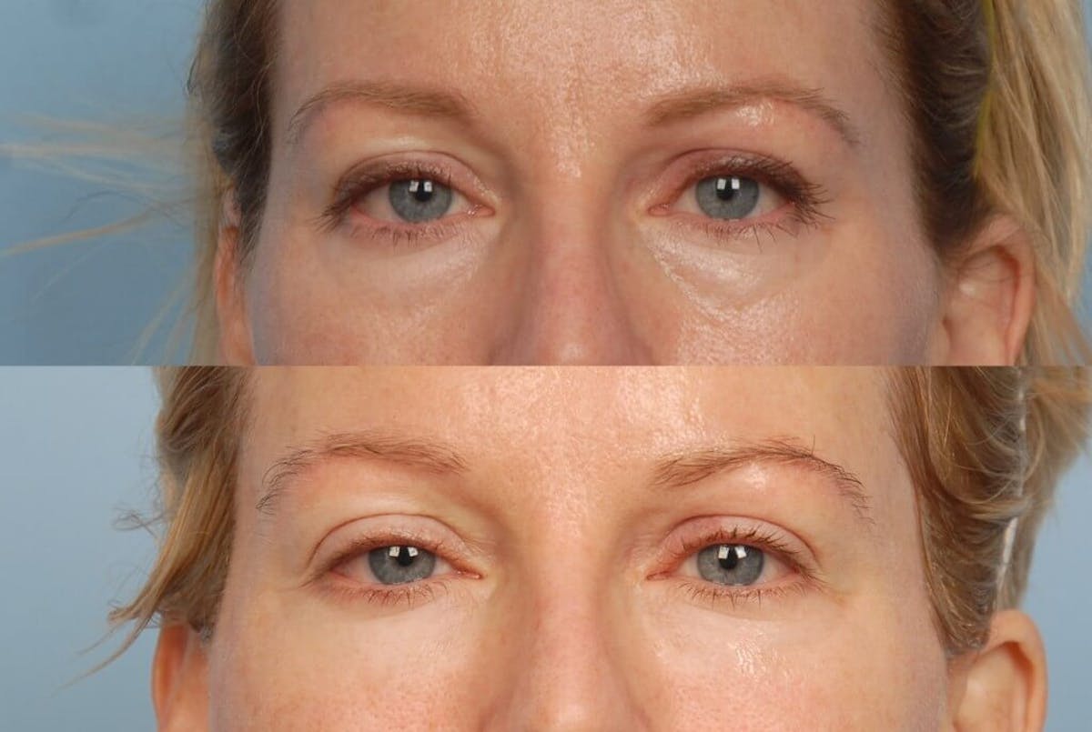 Eyes Before & After Gallery - Patient 331815 - Image 1