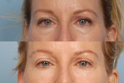 Eyes Before & After Gallery - Patient 331815 - Image 1