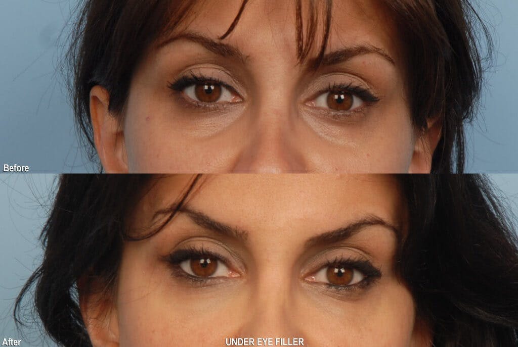 Fillers Before & After Gallery - Patient 173990409 - Image 1