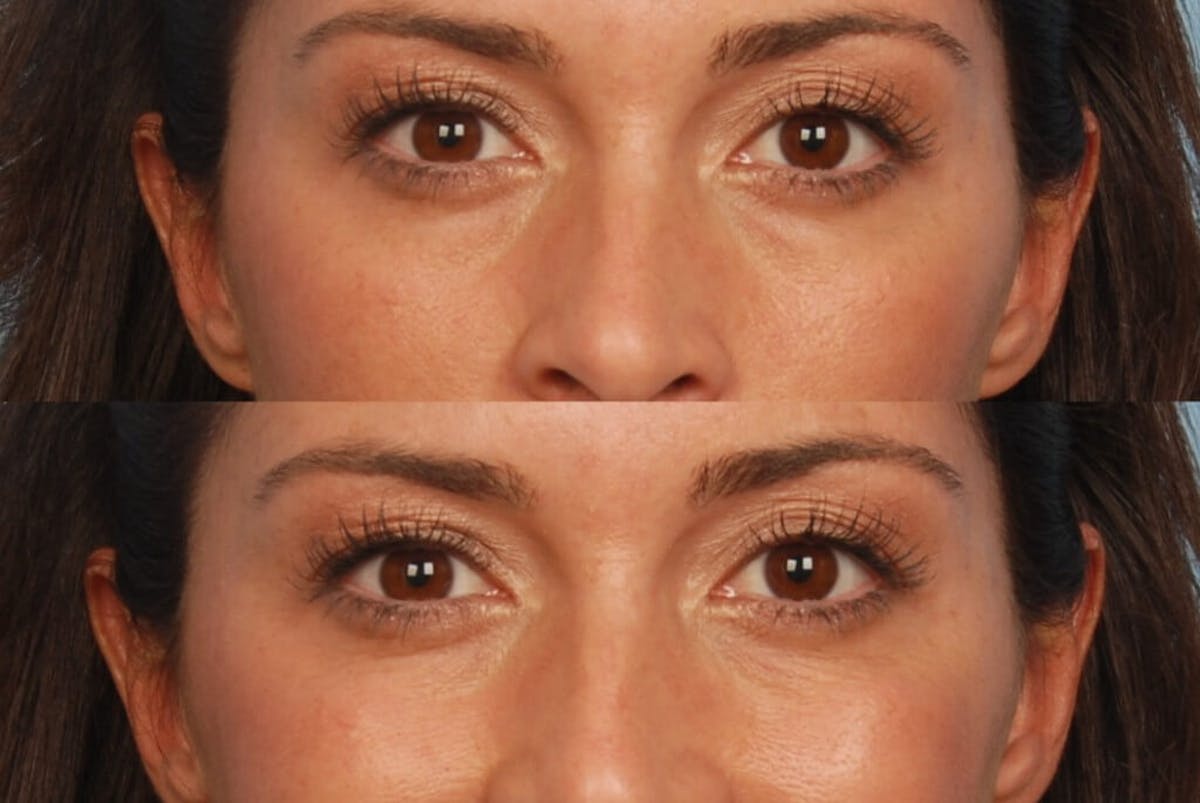 Eyes Before & After Gallery - Patient 778796 - Image 1