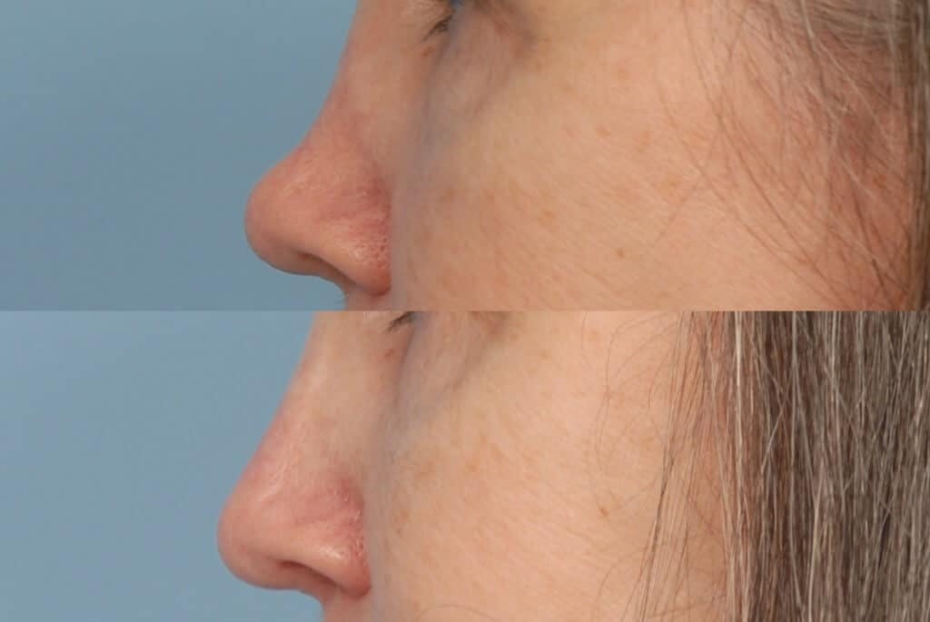Fillers Before & After Gallery - Patient 173990429 - Image 1