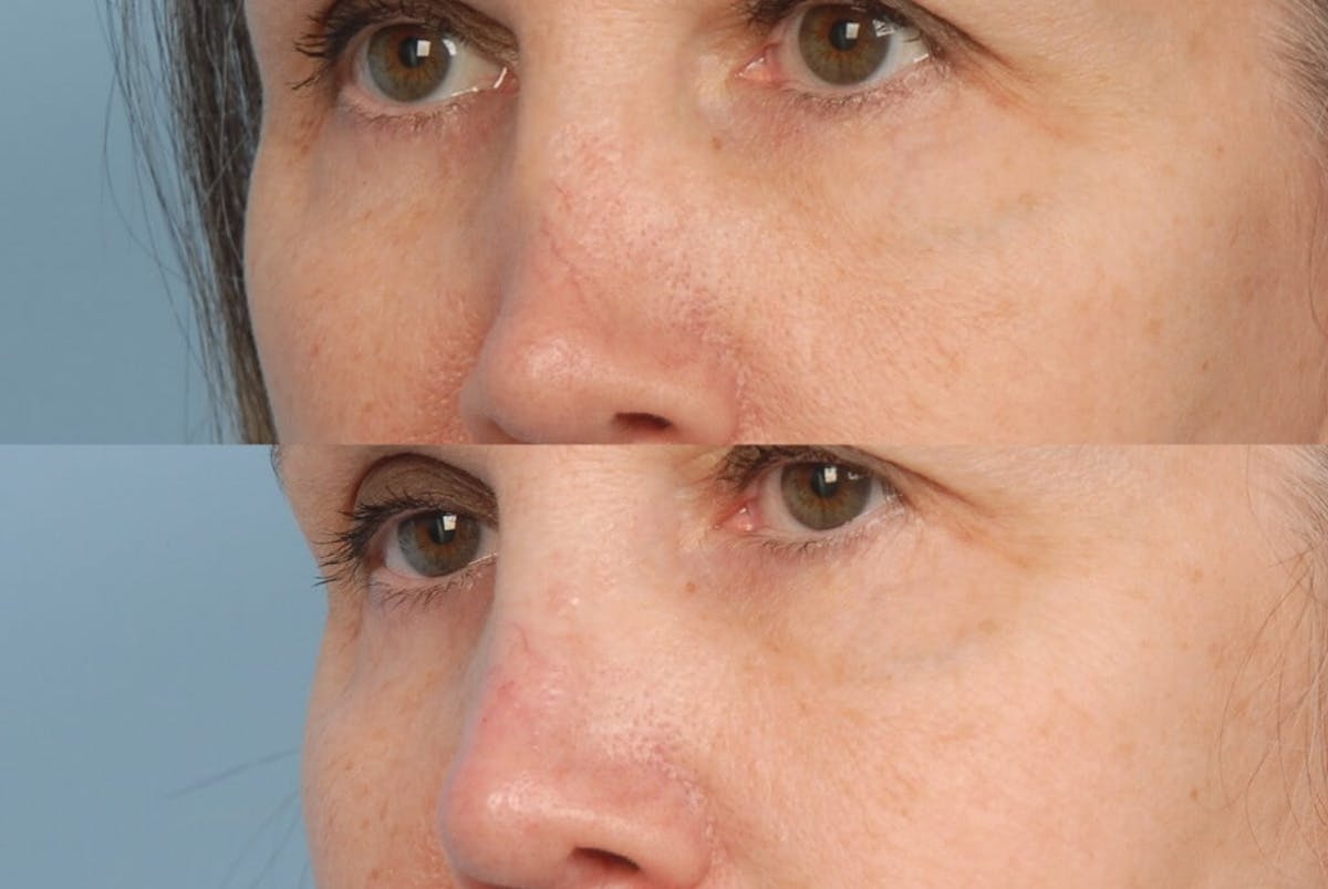 Lower Face Before & After Gallery - Patient 231148 - Image 1