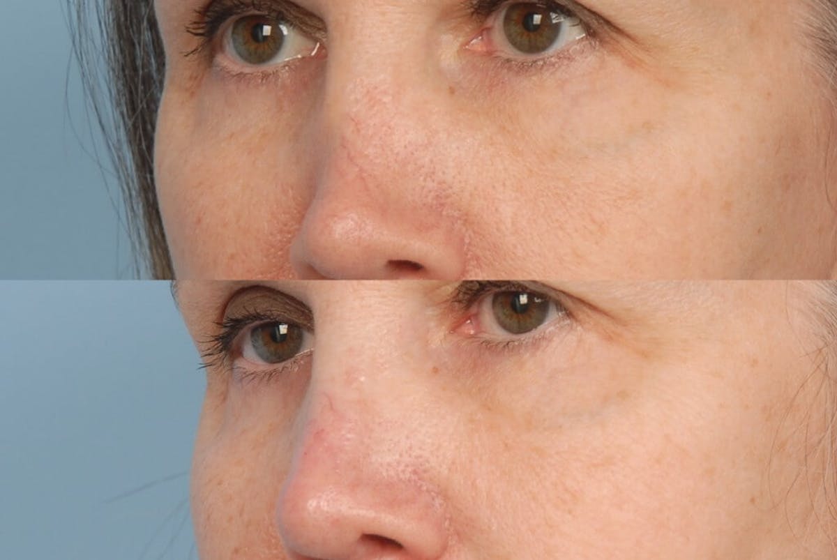 Fillers Before & After Gallery - Patient 173990430 - Image 1