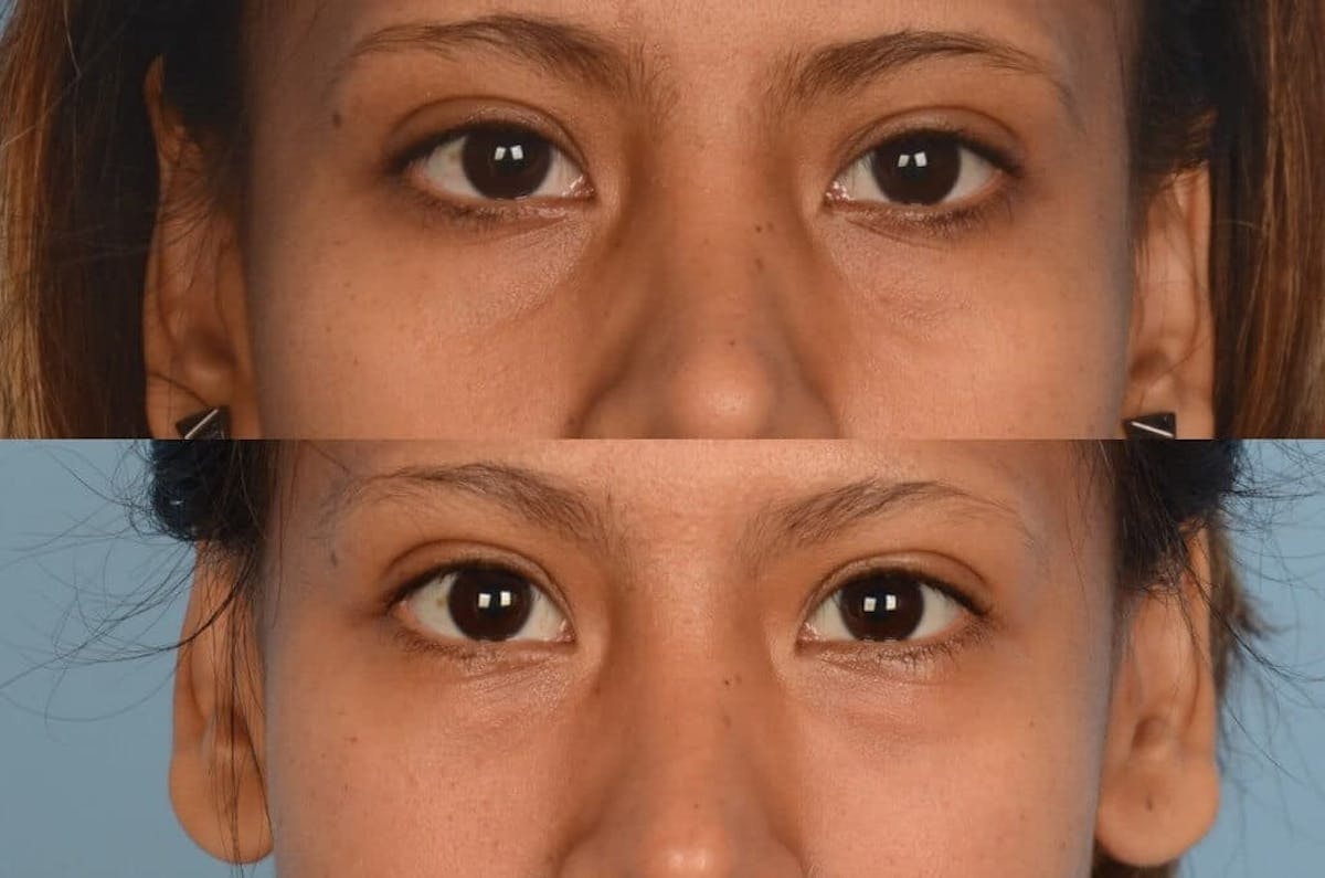 Fillers Before & After Gallery - Patient 173990431 - Image 1