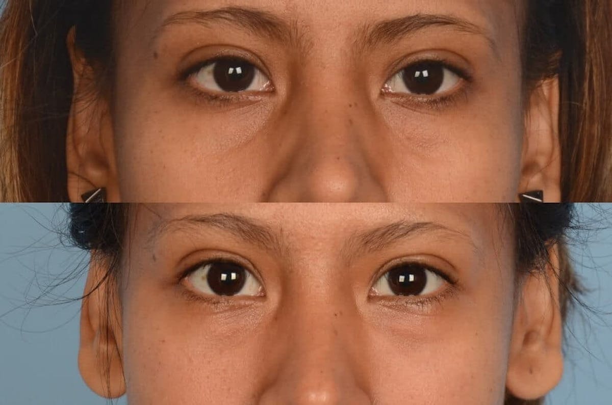 Eyes Before & After Gallery - Patient 404310 - Image 1