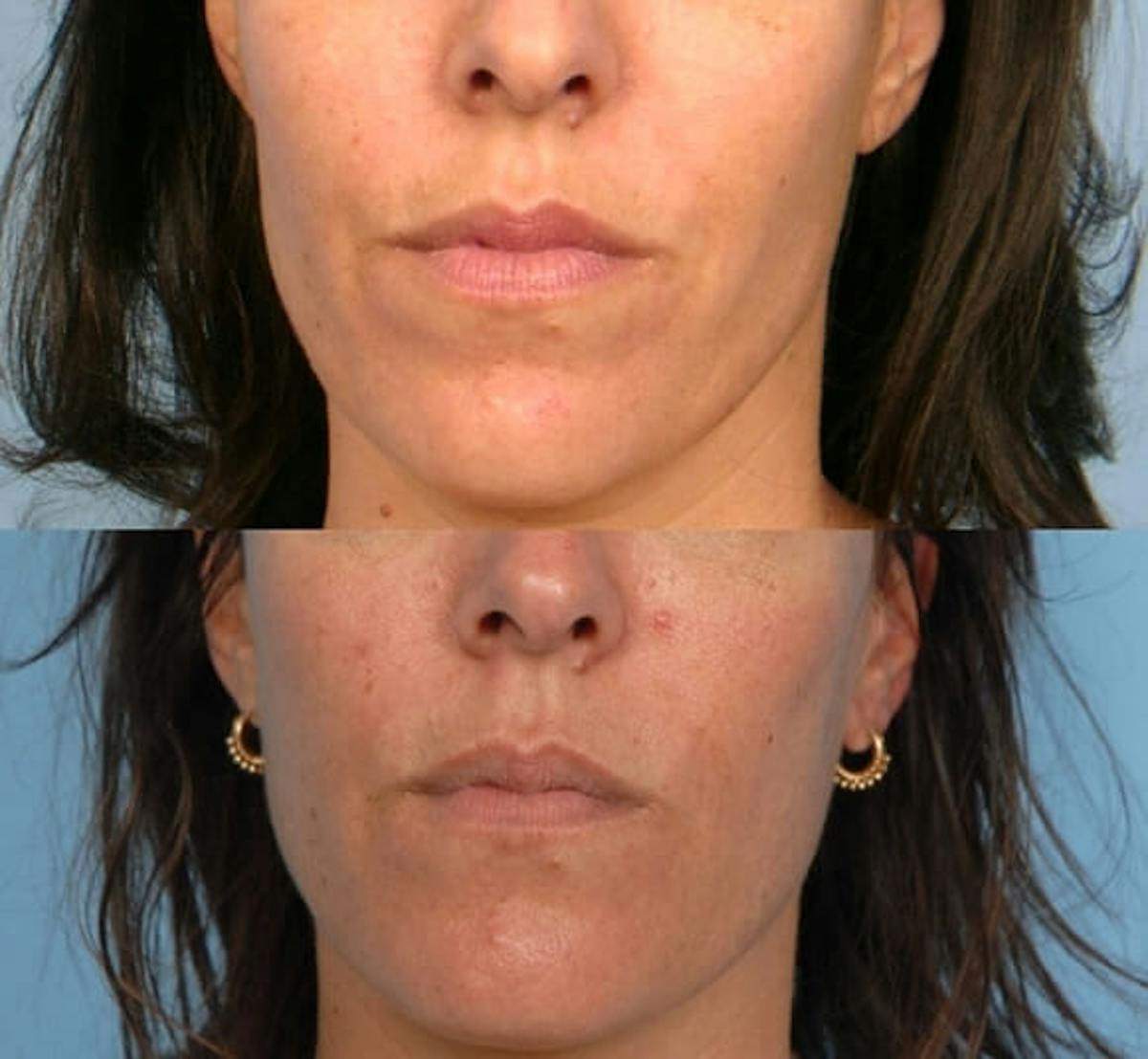 Fillers Before & After Gallery - Patient 173990671 - Image 1
