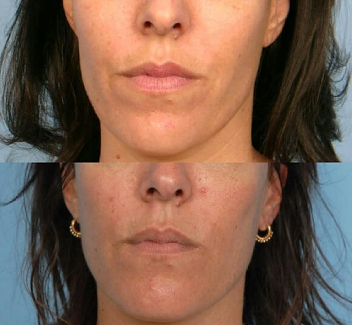Lower Face Before & After Gallery - Patient 276859 - Image 1