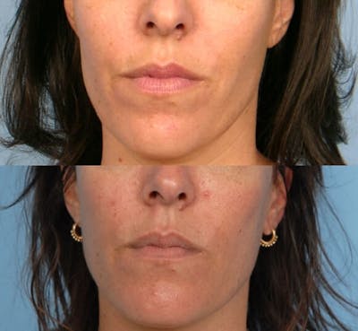 Lower Face Before & After Gallery - Patient 276859 - Image 1