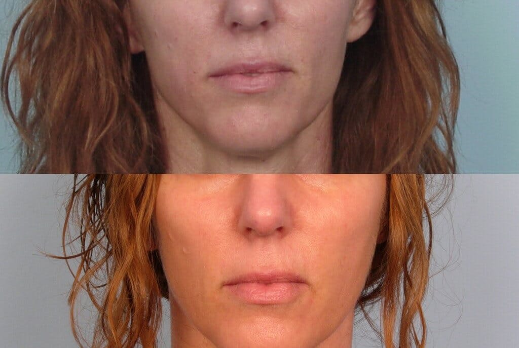 Sculptra Before & After Gallery - Patient 42065759 - Image 1