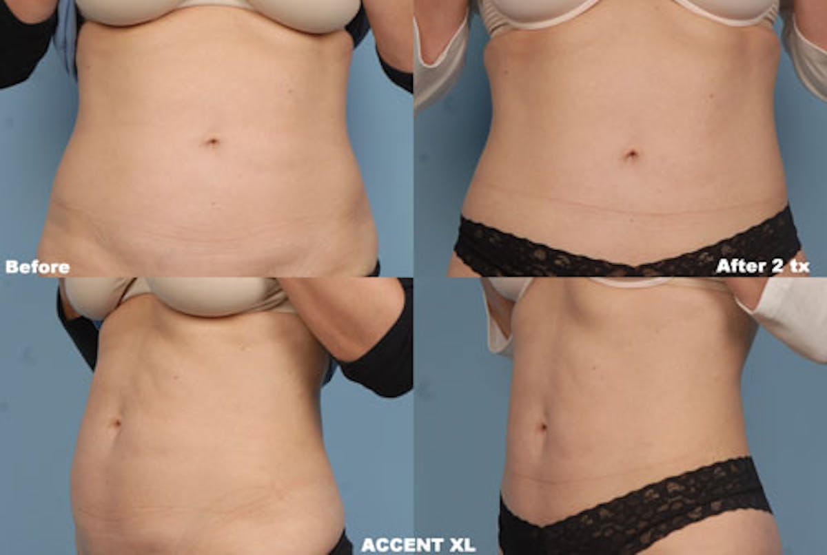 Cellulite Treatment Before & After Gallery - Patient 42065773 - Image 1