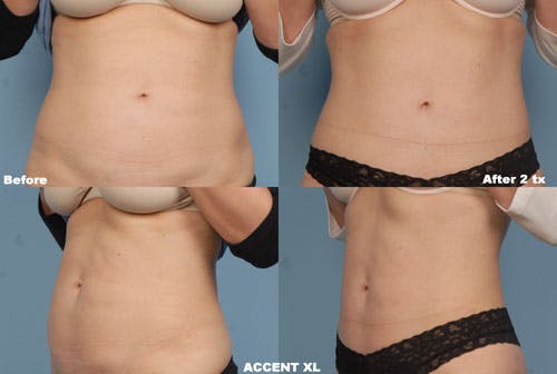 Accent XL Laser Before & After Gallery - Patient 42065773 - Image 1