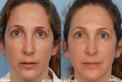 Active FX Laser Before & After Gallery - Patient 42065774 - Image 1