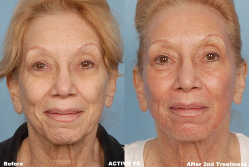 Active FX Laser Before & After Gallery - Patient 42065775 - Image 1