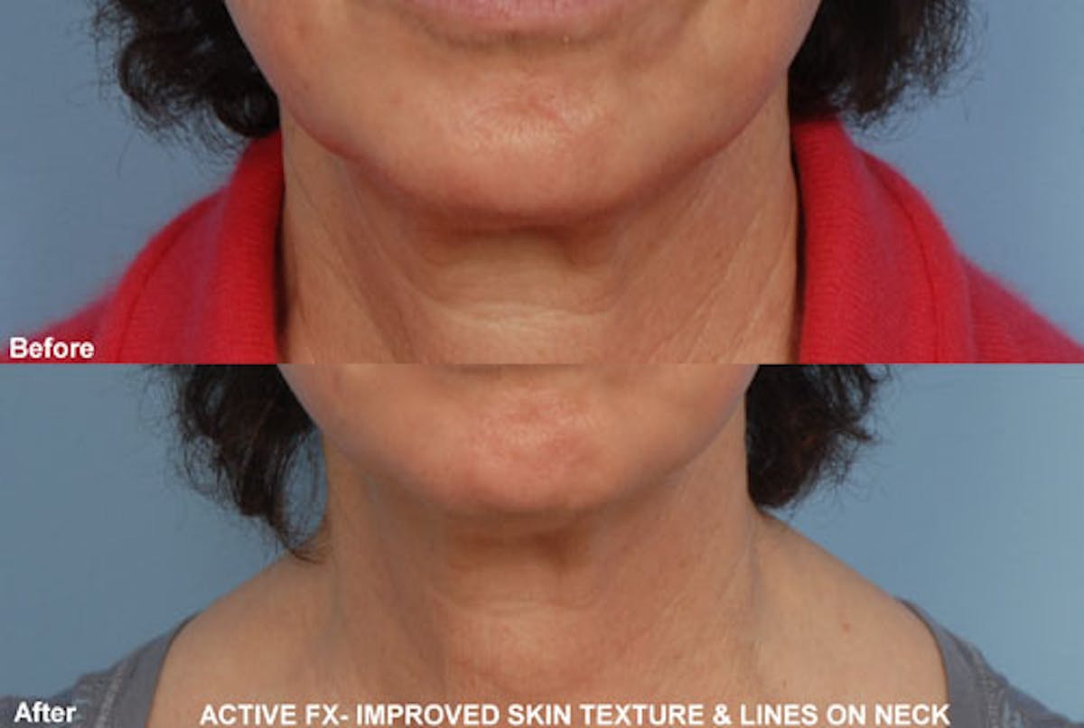 Active FX Laser Before & After Gallery - Patient 42065776 - Image 1