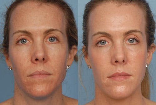 Active FX Laser Before & After Gallery - Patient 42065777 - Image 1