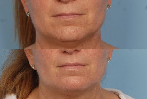Active FX Laser Before & After Gallery - Patient 42065778 - Image 1