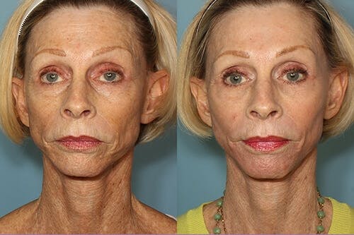 Active FX Laser Before & After Gallery - Patient 42065779 - Image 1