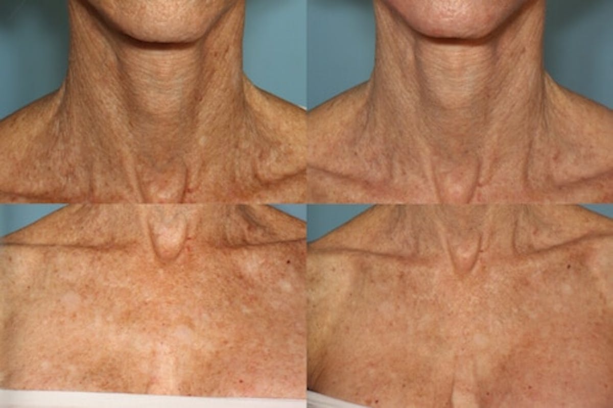 Active FX Laser Before & After Gallery - Patient 42065780 - Image 1