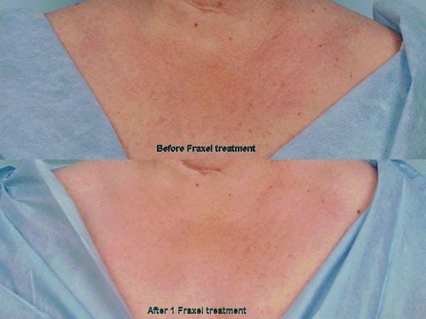 Fraxel Laser Treatment