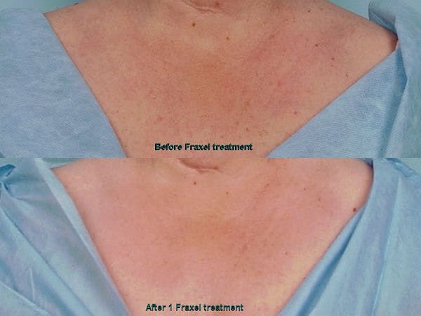Fraxel Laser Before & After Gallery - Patient 42065793 - Image 1
