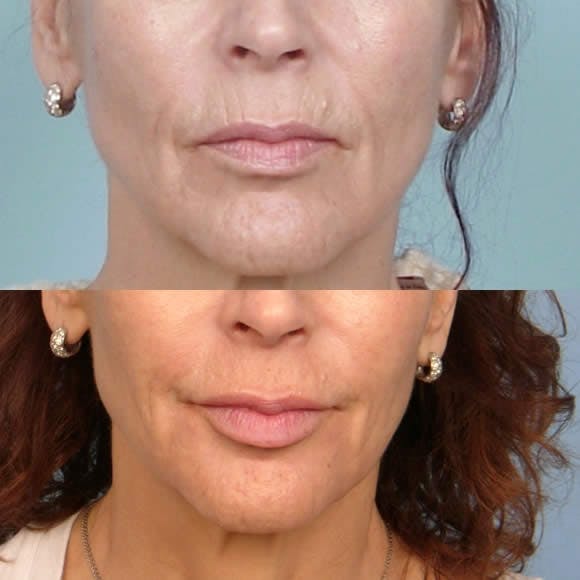 Fraxel Laser Before & After Gallery - Patient 42065794 - Image 1