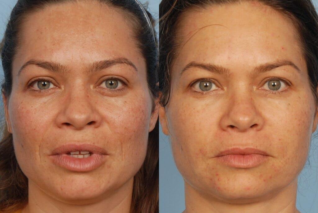 Fraxel Laser Before & After Gallery - Patient 42065795 - Image 1