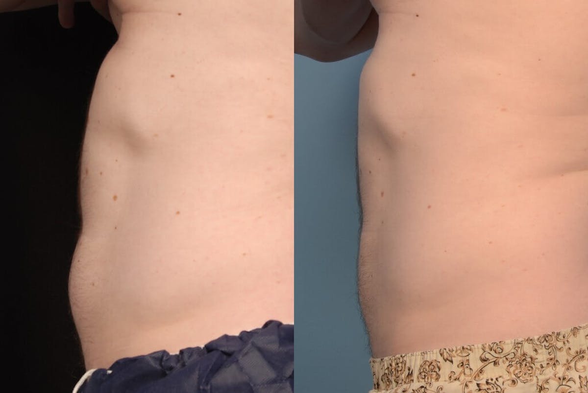 CoolSculpting Before & After Gallery - Patient 44232745 - Image 1
