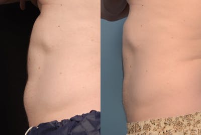 Non-Invasive Fat Reduction Before & After Gallery - Patient 44232745 - Image 1