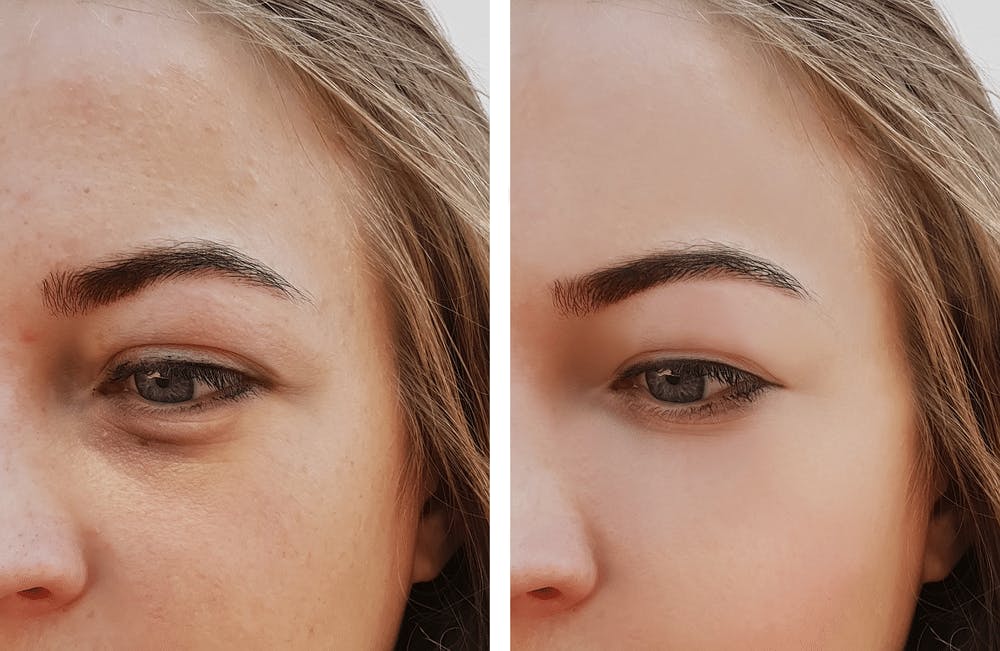 Under Eye Filler Benefits Of Belotero Grossman Dermatology