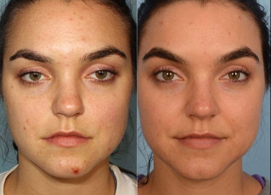 Acne & Acne Scars