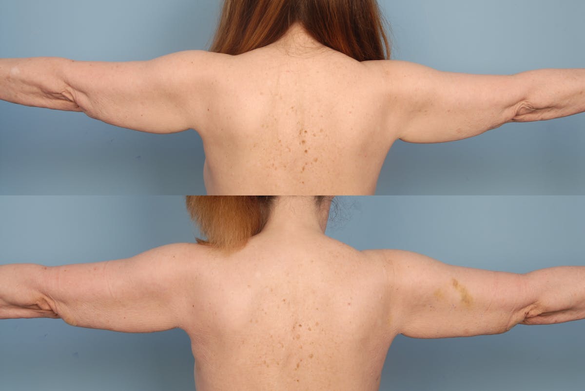 SmartLipo Before & After Gallery - Patient 48369703 - Image 2