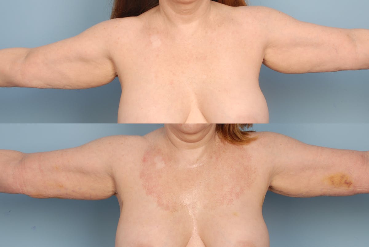 SmartLipo Before & After Gallery - Patient 48369703 - Image 1