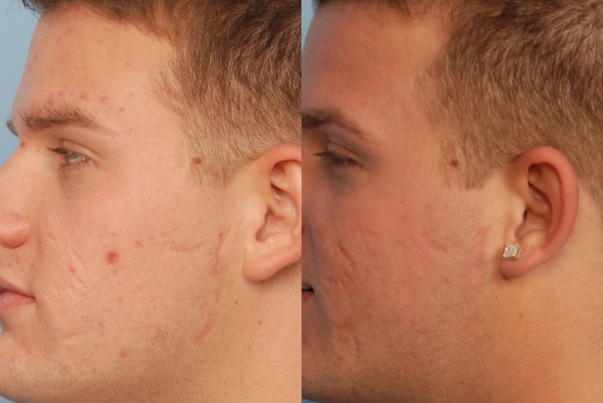CO2 Laser Resurfacing Before & After Gallery - Patient 48369724 - Image 1