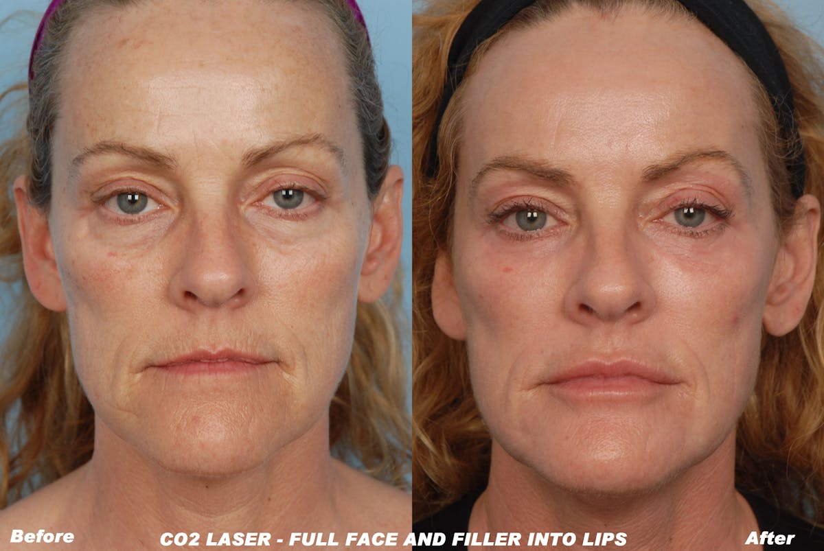 CO2 LASER TREATMENT BEFORE & AFTER PHOTOS