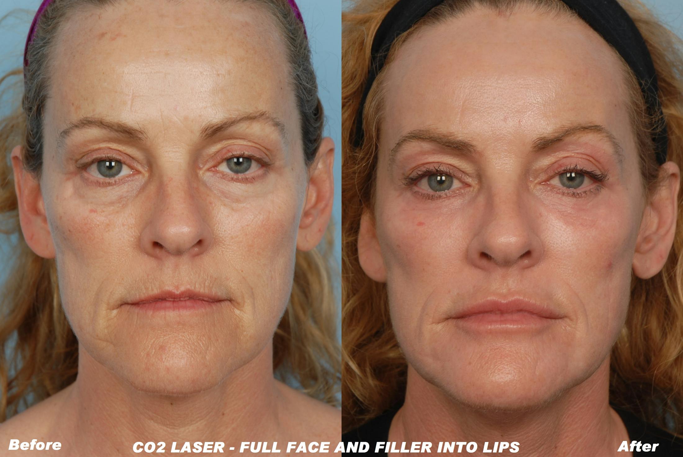 CO2 Laser Resurfacing Before & After Gallery - Patient 48369725 - Image 1