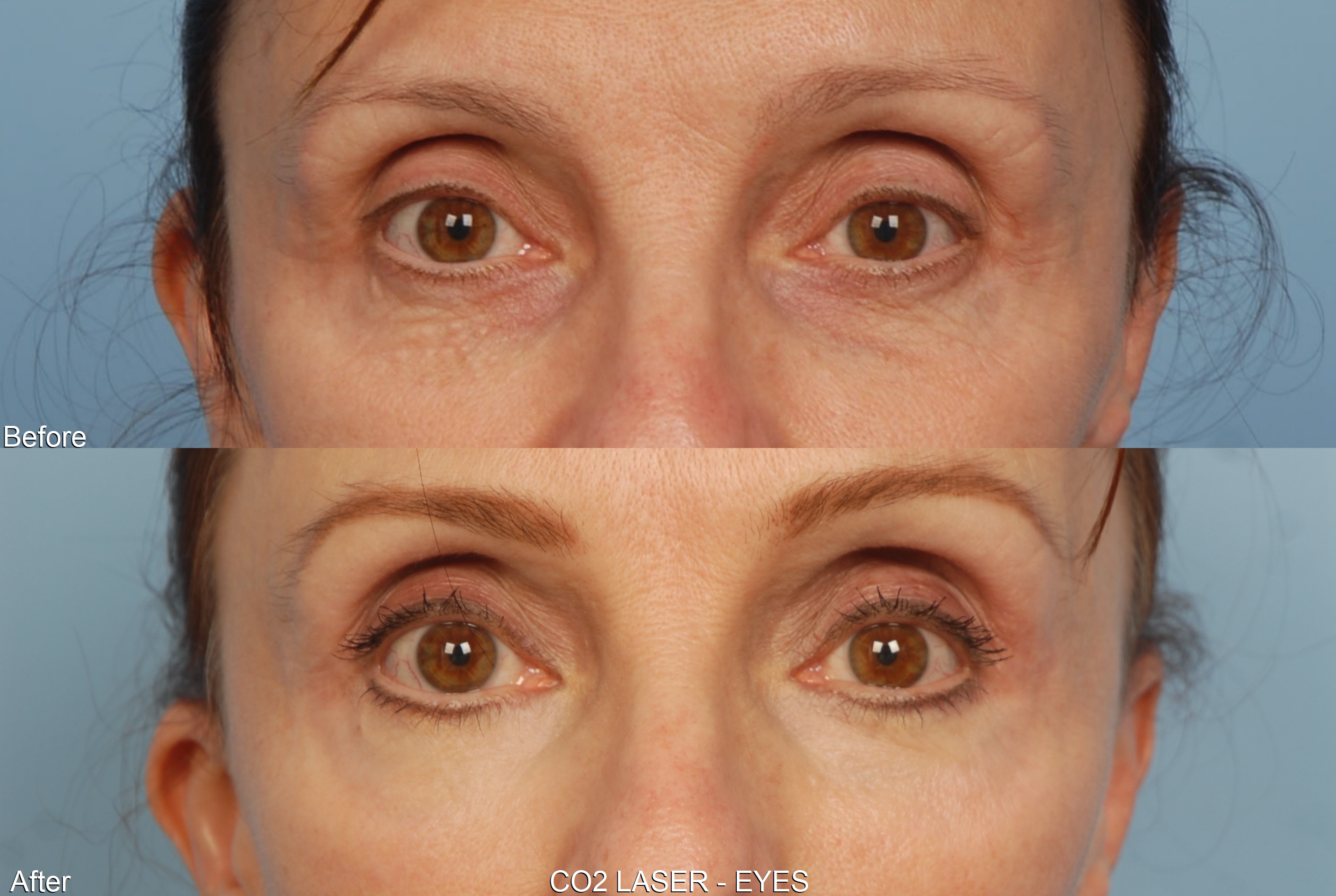 Laser Resurfacing Before and After Pictures of Actual Patients