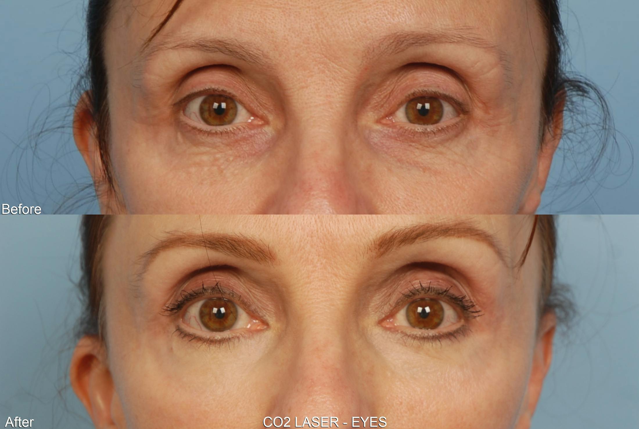 CO2 Laser Resurfacing Before & After Gallery - Patient 48369726 - Image 1