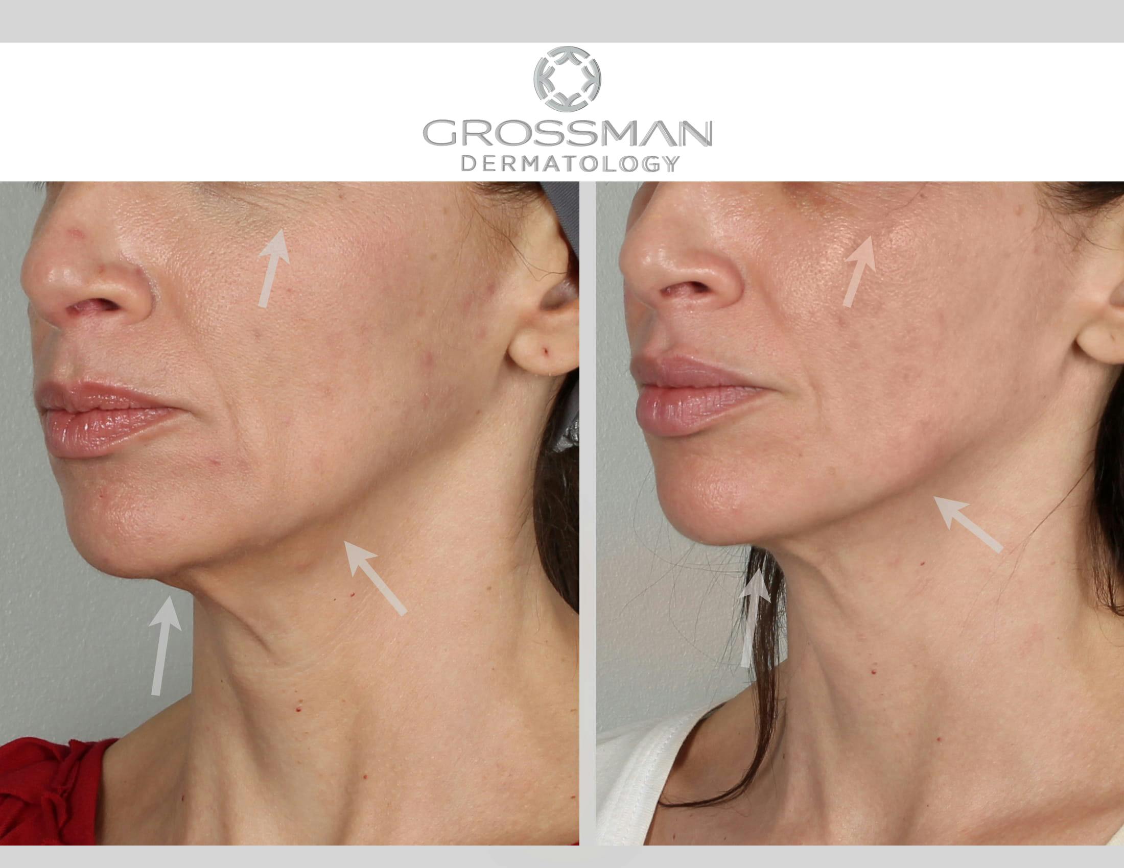 FaceTite & NeckTite Before & After Gallery - Patient 48369787 - Image 3