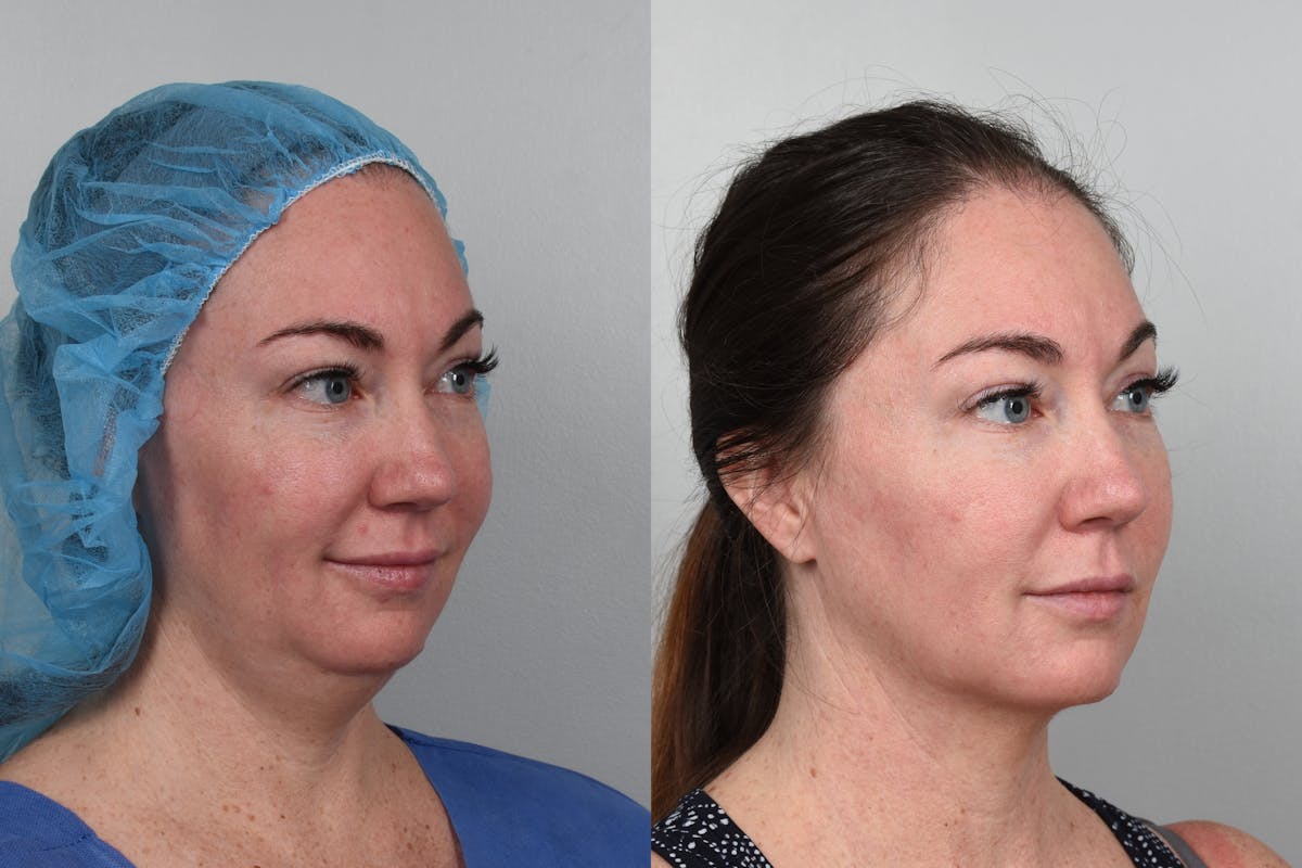 FaceTite & NeckTite Before & After Gallery - Patient 48369788 - Image 1