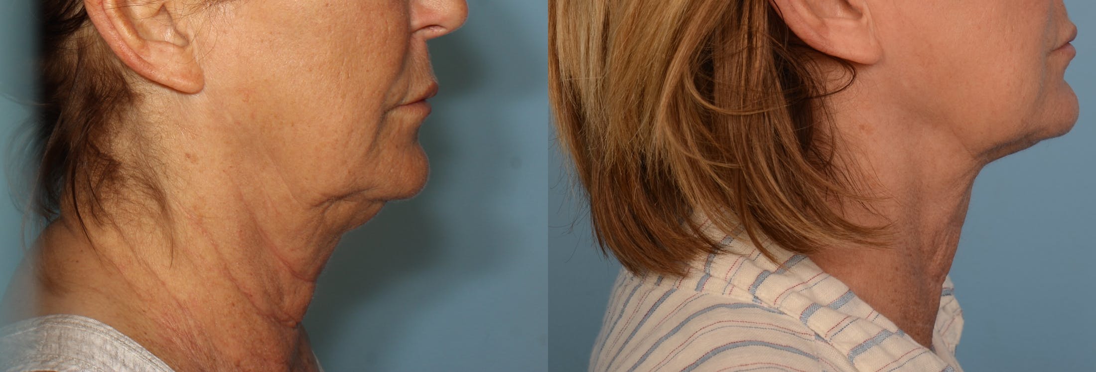 FaceTite & NeckTite Before & After Gallery - Patient 48369790 - Image 1