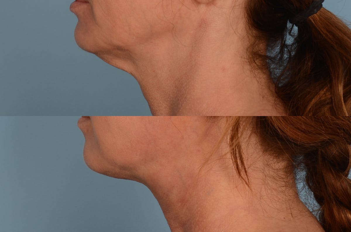 Thread Lift Before & After Gallery - Patient 48369801 - Image 1